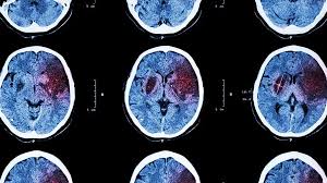 Rééducation Post-AVC par Neurofeedback: Cas d’Étude